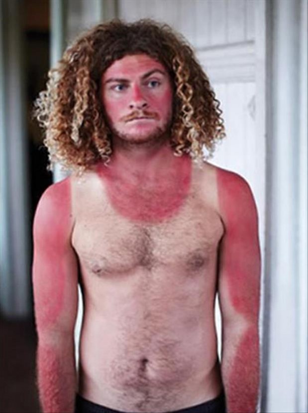 sunburn-pictures-dumpaday-2